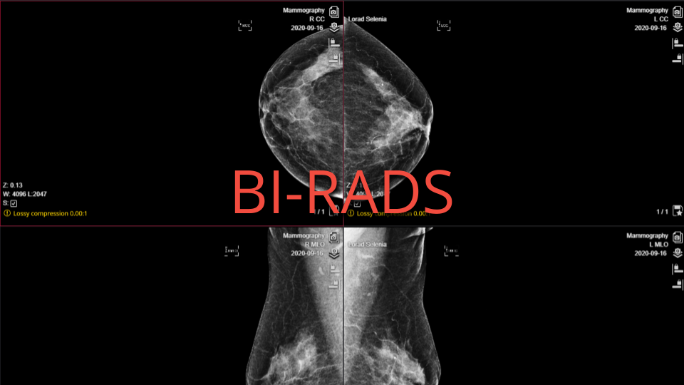 BI-RADS in Medical Imaging Research: Standardizing Breast Cancer ...