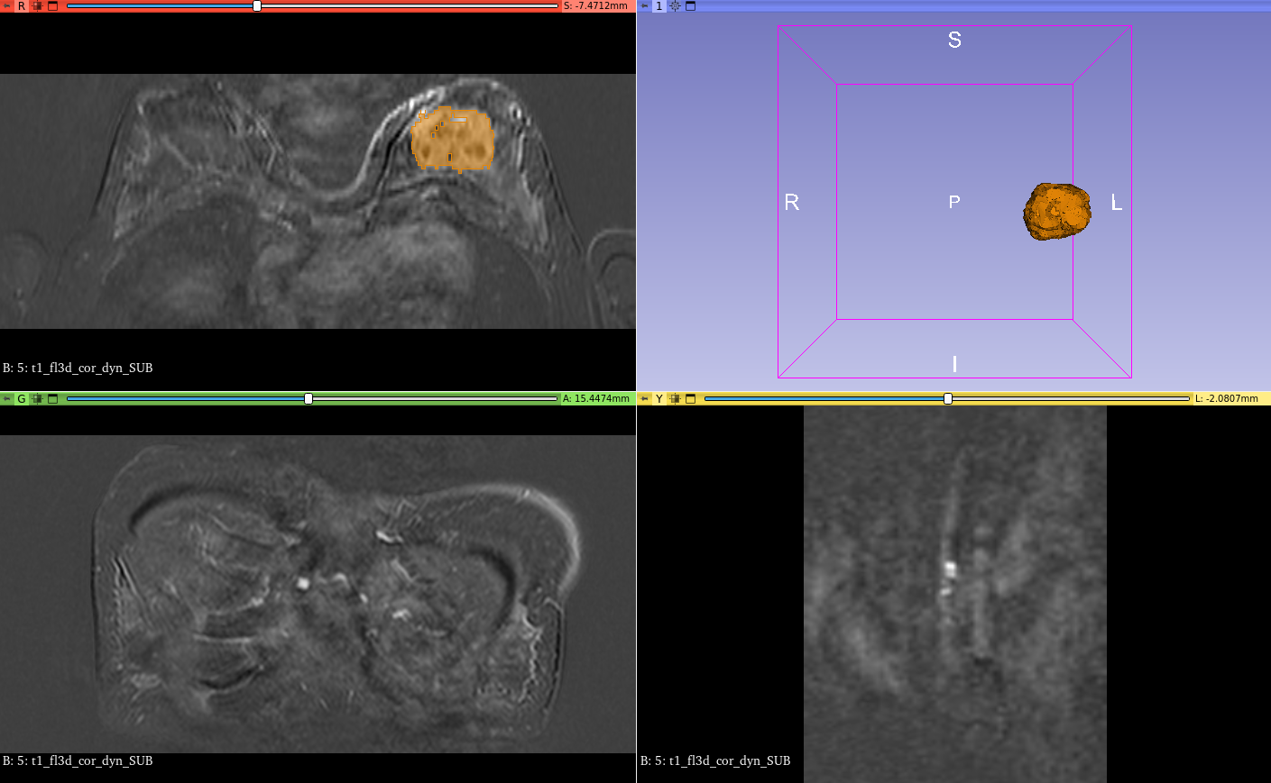 DICOM images used for cancer lesion segmentation projected in 3D.