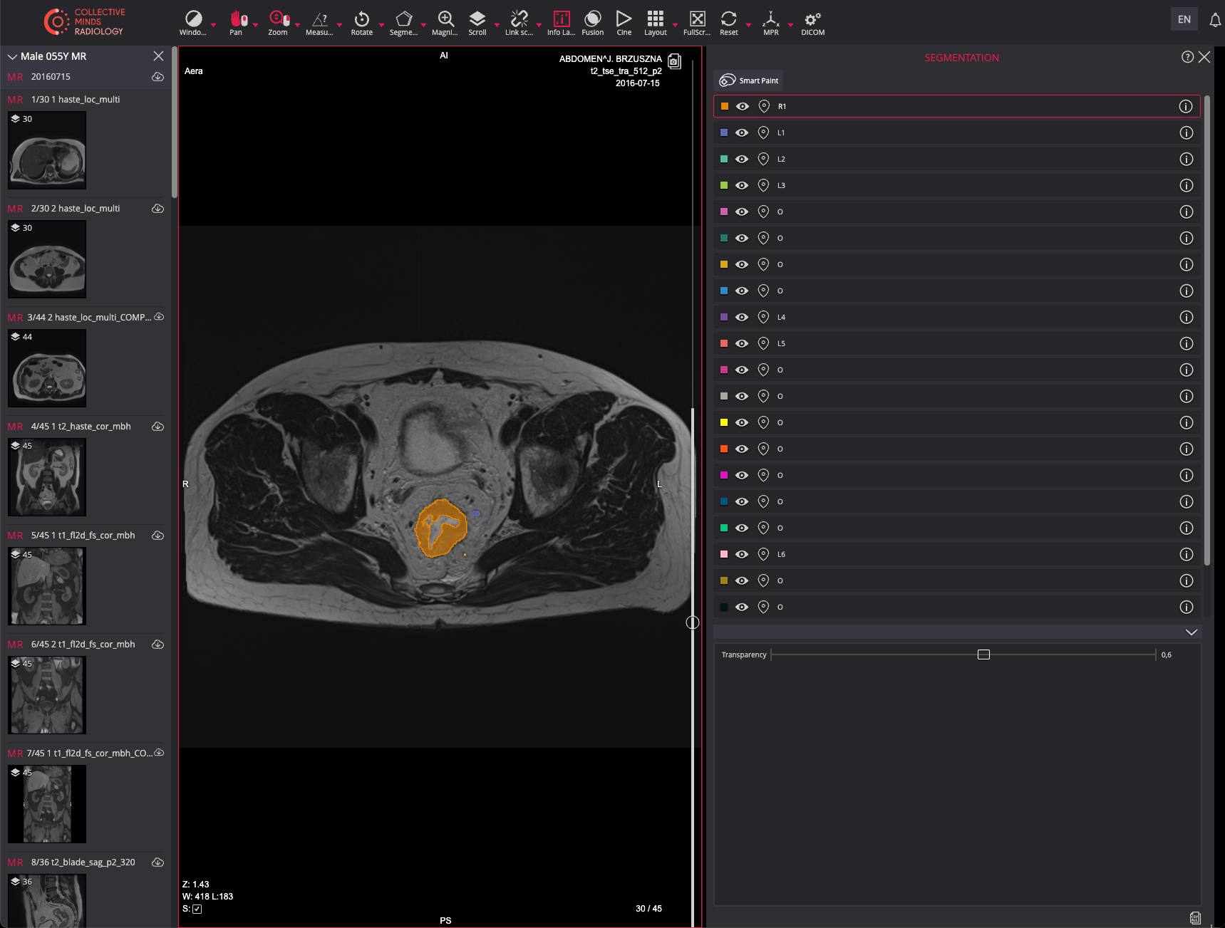 Collective Minds Reserach DICOM Segmentation RTSTRUCT Rectal Cancer Lymph Node Lesions