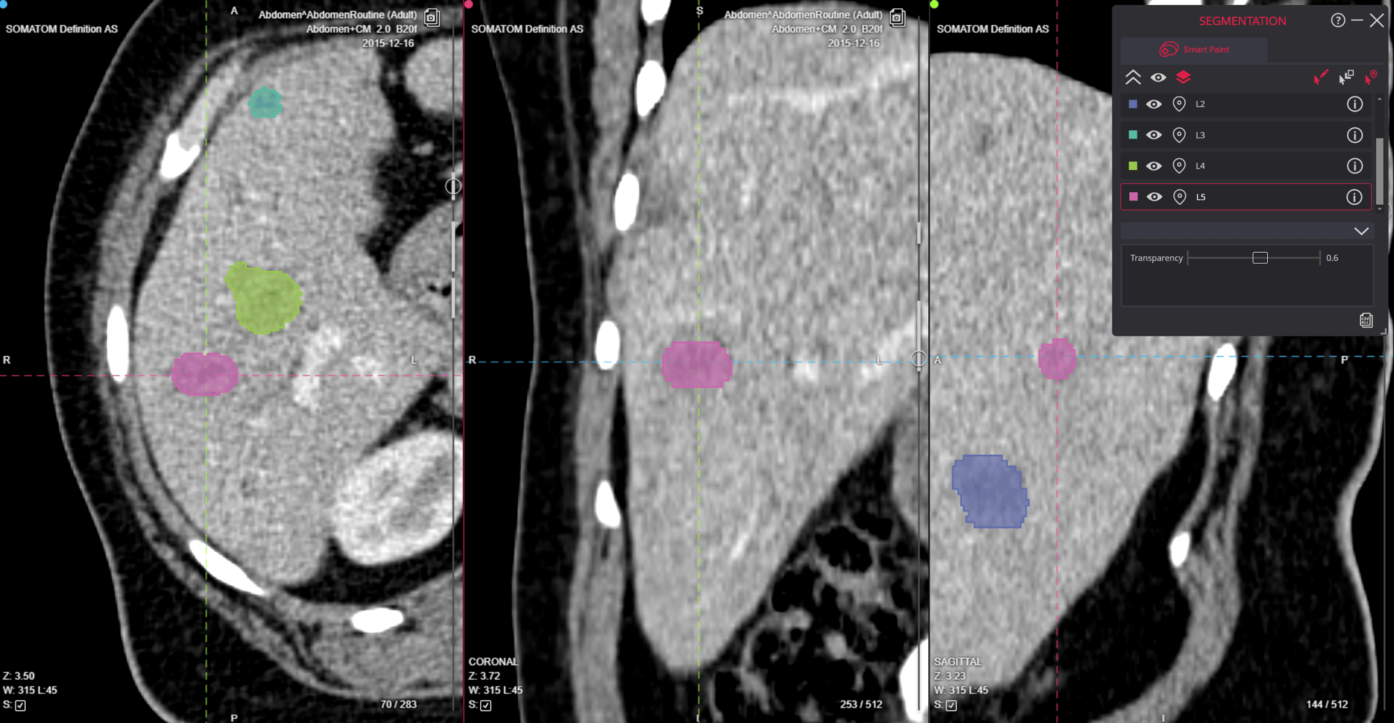 Innovating Radiology with Smart Paint A Game-Changer in Medical Imaging Segmentation image