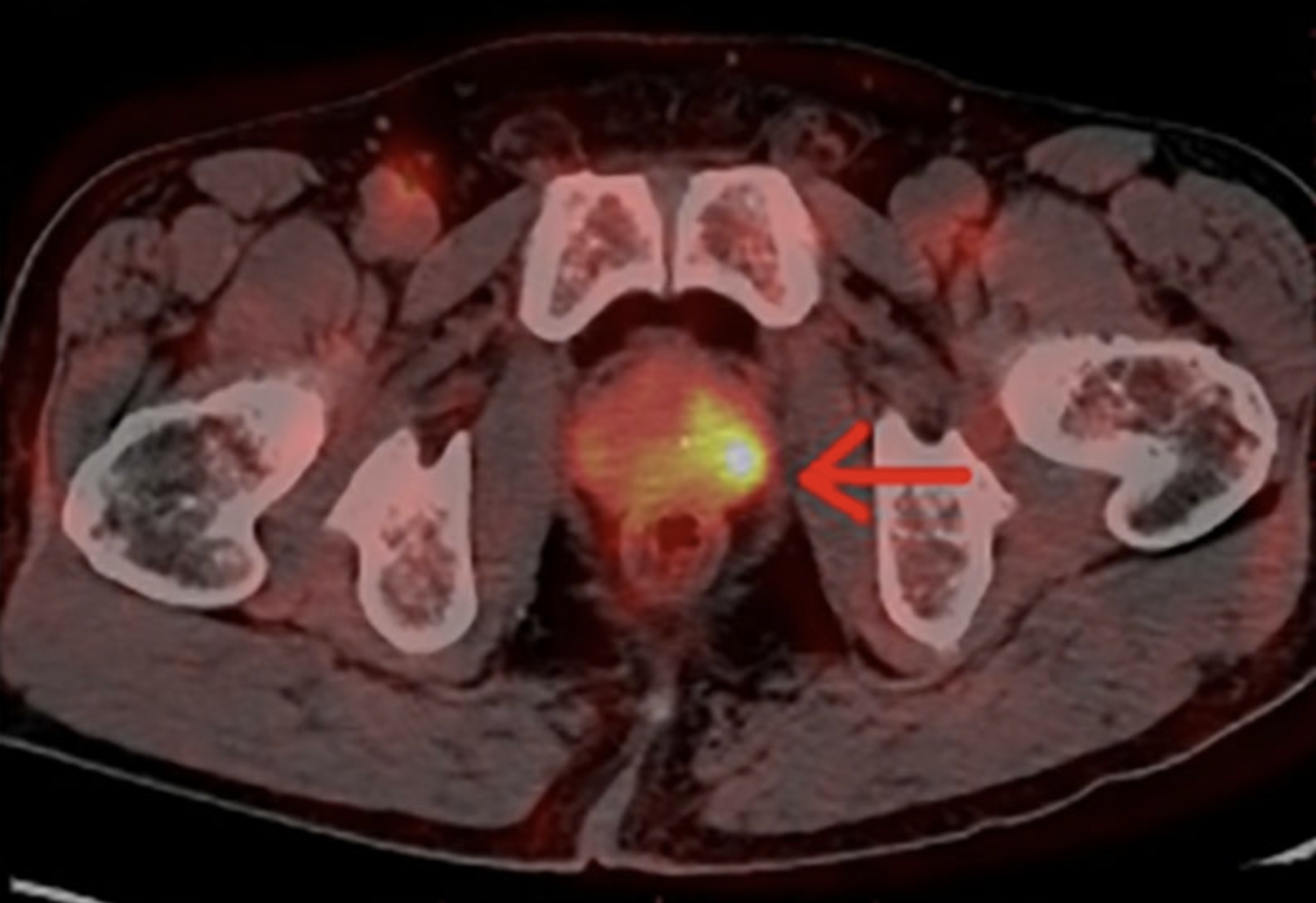 PET MR cancer imaging