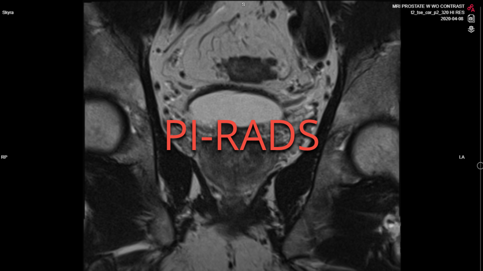 PI-RADS standard and medical imaging research