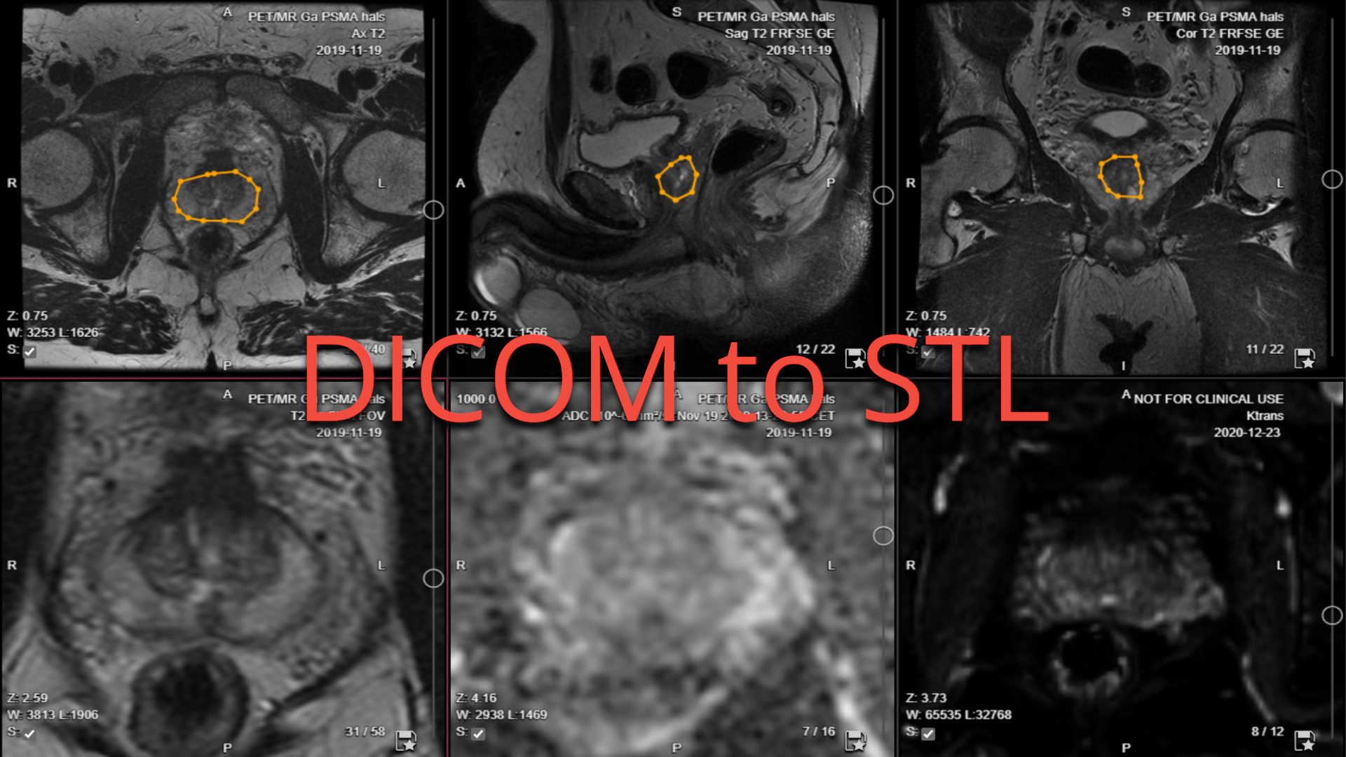 collective minds research segmentation DICOM to STL